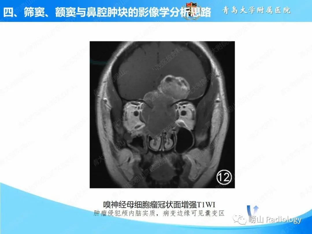 影像PPT - 【PPT】鼻腔鼻窦肿瘤和肿瘤样病变的影像学分析思路-27