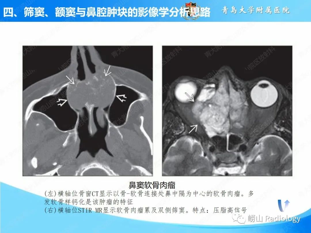 影像PPT - 【PPT】鼻腔鼻窦肿瘤和肿瘤样病变的影像学分析思路-28