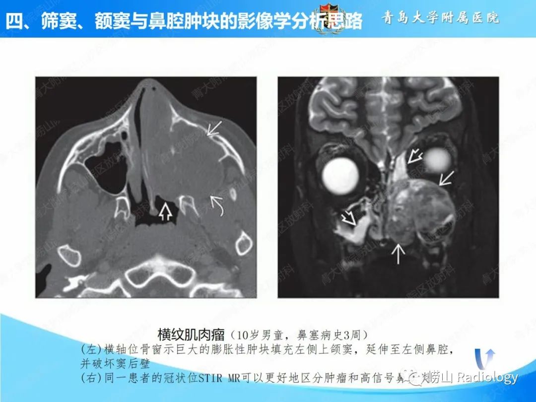 影像PPT - 【PPT】鼻腔鼻窦肿瘤和肿瘤样病变的影像学分析思路-29