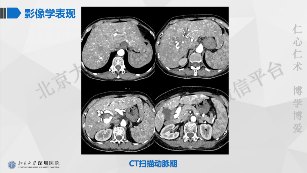 影像PPT - 【PPT】遗传性出血性毛细血管扩张症-3
