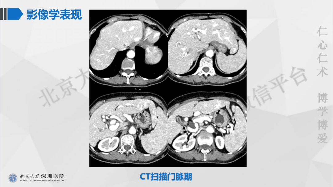 影像PPT - 【PPT】遗传性出血性毛细血管扩张症-4