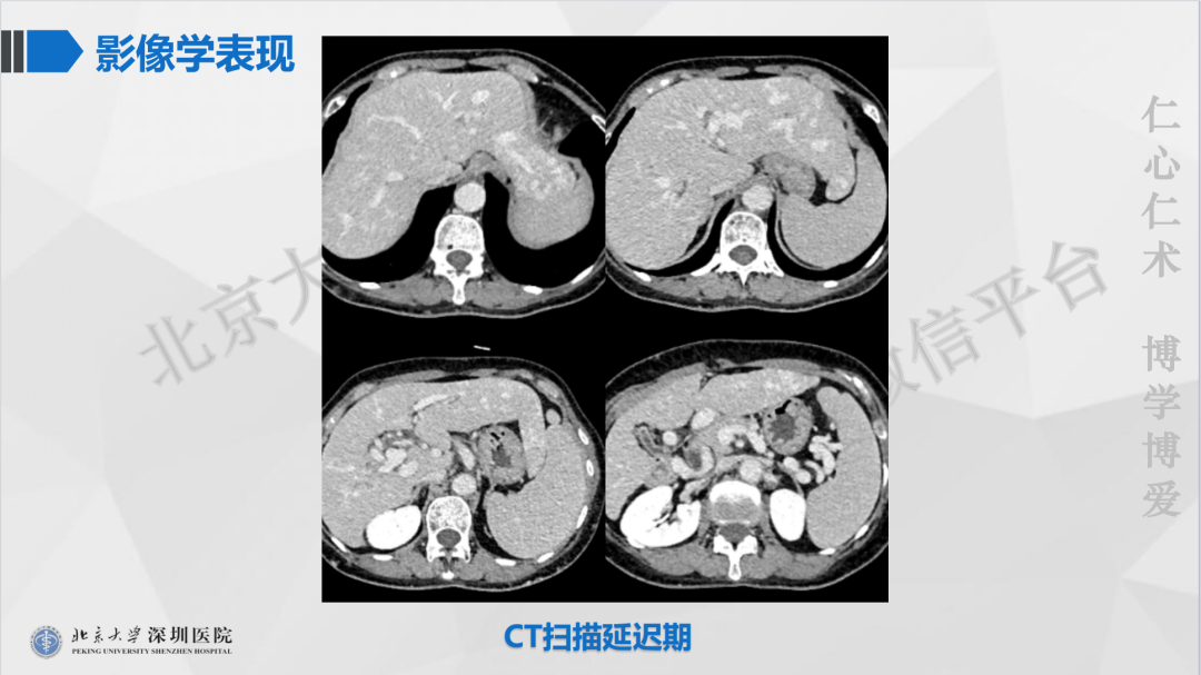 影像PPT - 【PPT】遗传性出血性毛细血管扩张症-5
