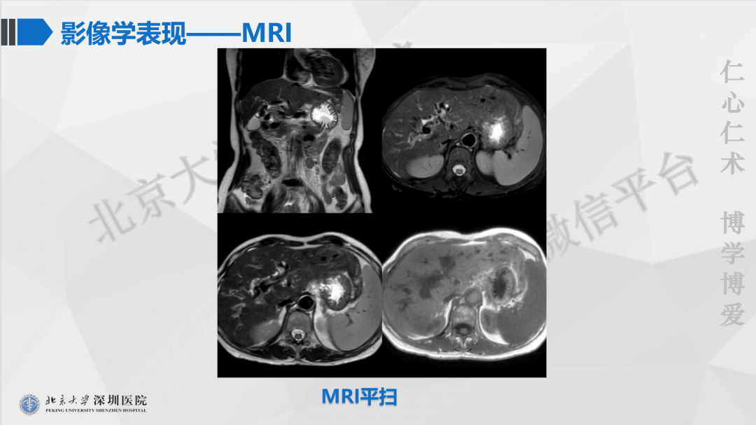 影像PPT - 【PPT】遗传性出血性毛细血管扩张症-7