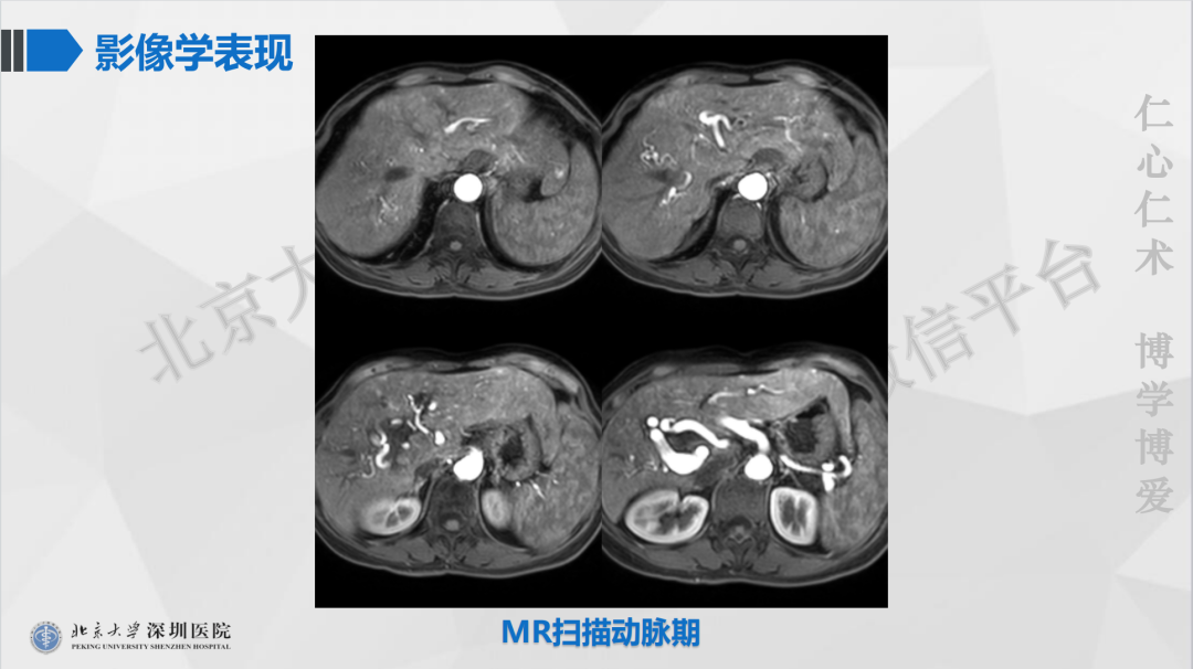 影像PPT - 【PPT】遗传性出血性毛细血管扩张症-8