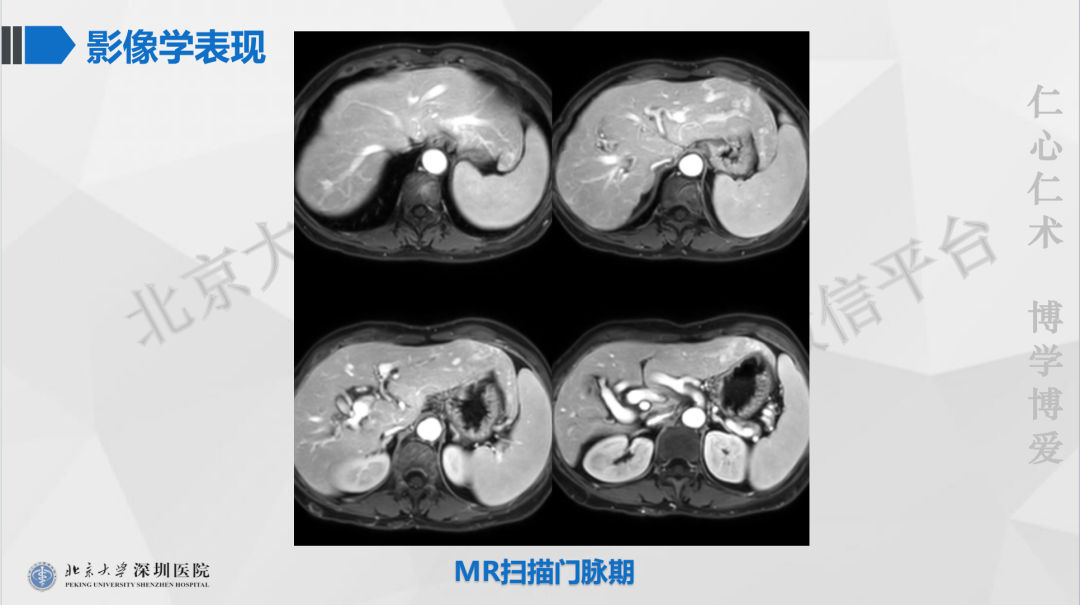 影像PPT - 【PPT】遗传性出血性毛细血管扩张症-9