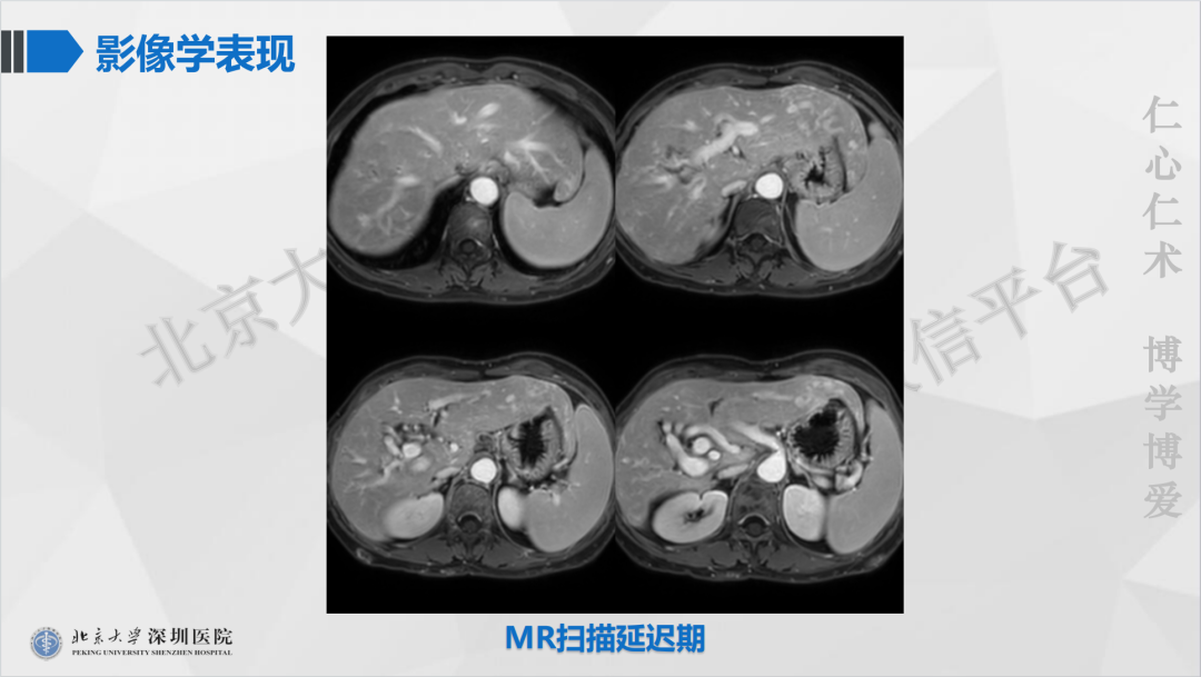 影像PPT - 【PPT】遗传性出血性毛细血管扩张症-10