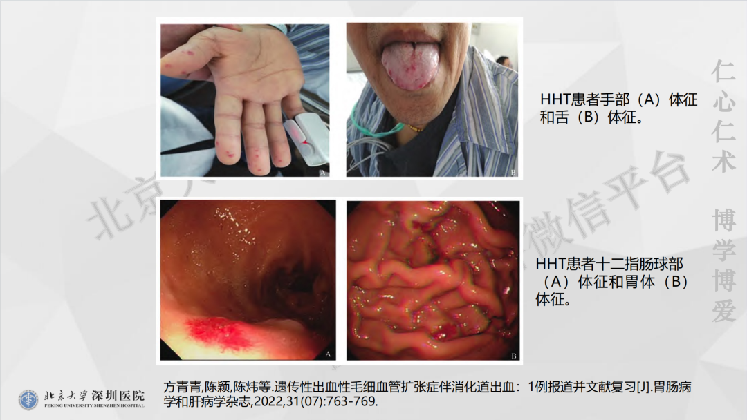 影像PPT - 【PPT】遗传性出血性毛细血管扩张症-22