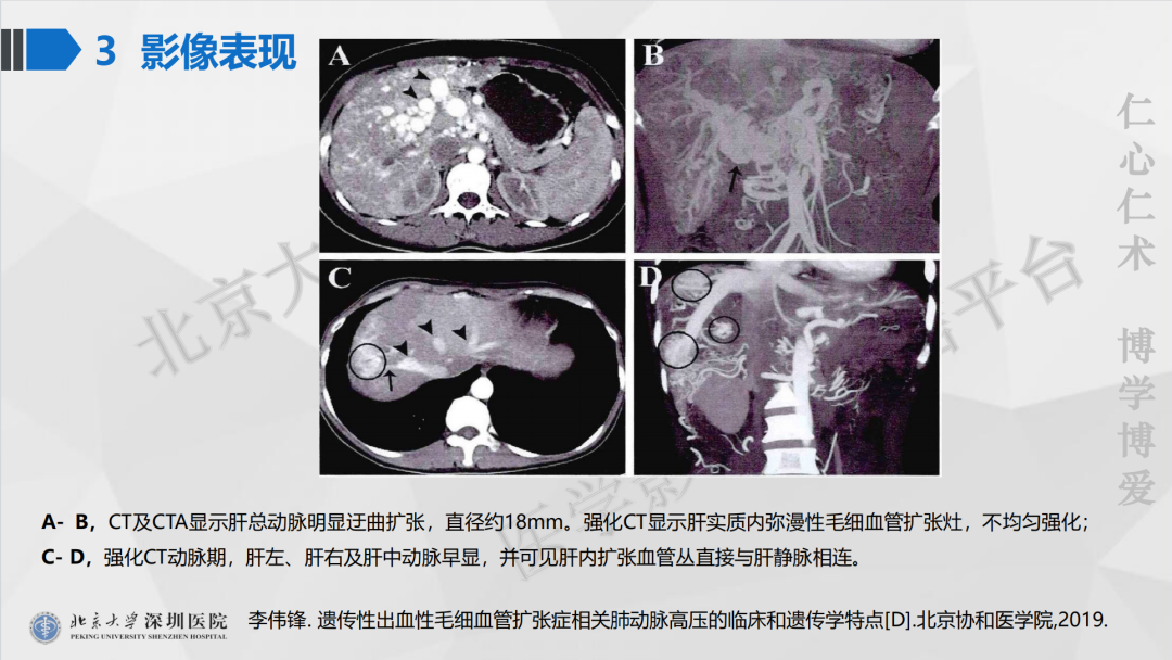 影像PPT - 【PPT】遗传性出血性毛细血管扩张症-28