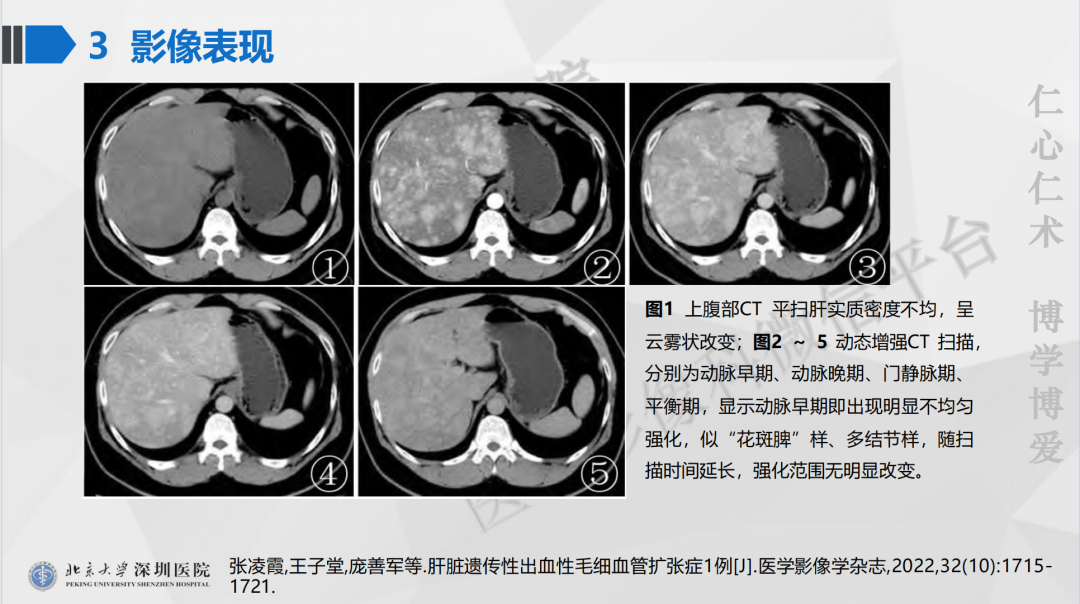 影像PPT - 【PPT】遗传性出血性毛细血管扩张症-30