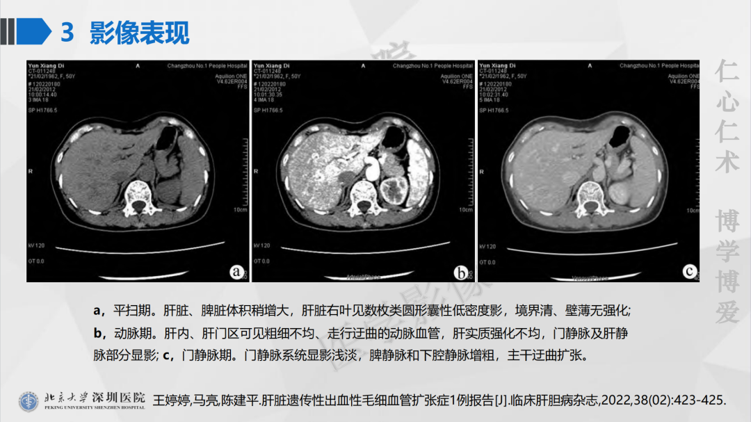 影像PPT - 【PPT】遗传性出血性毛细血管扩张症-31