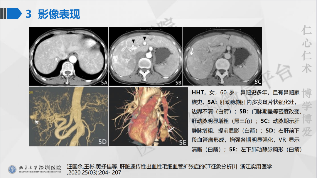 影像PPT - 【PPT】遗传性出血性毛细血管扩张症-32