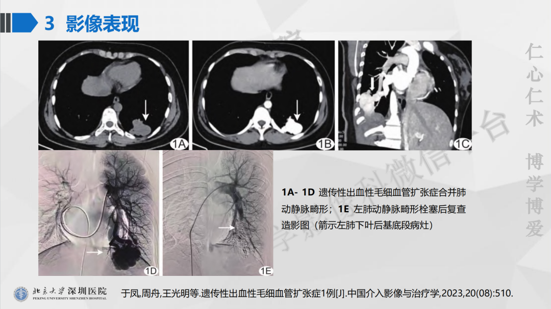 影像PPT - 【PPT】遗传性出血性毛细血管扩张症-33