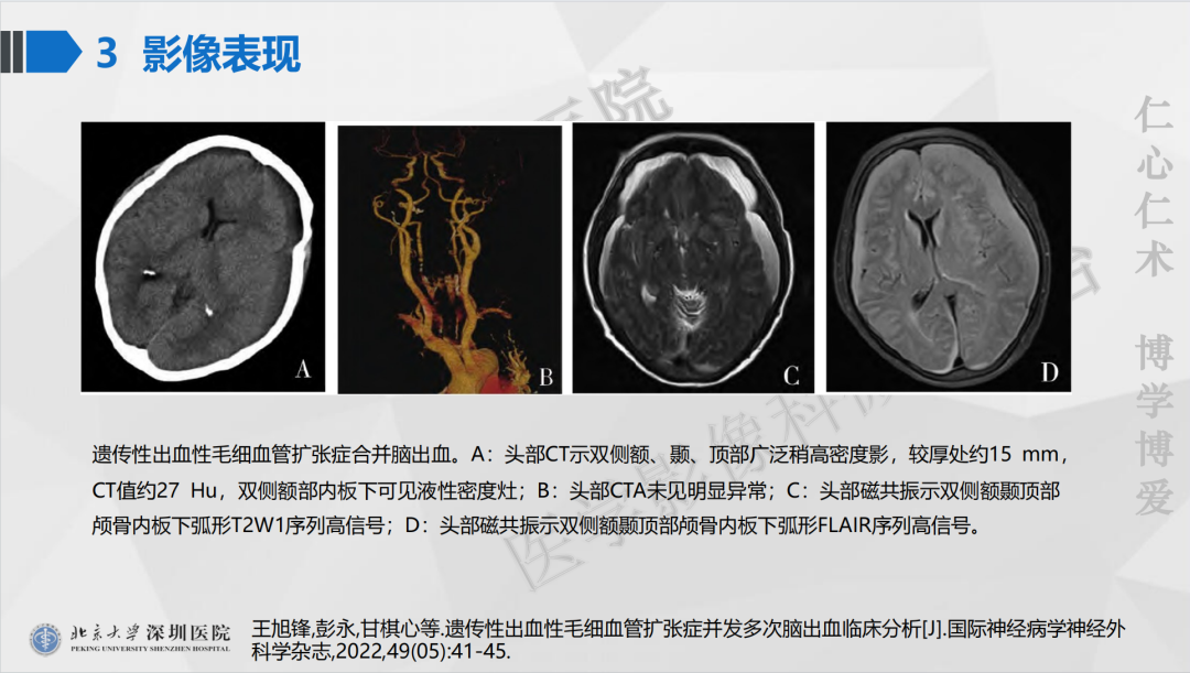 影像PPT - 【PPT】遗传性出血性毛细血管扩张症-34
