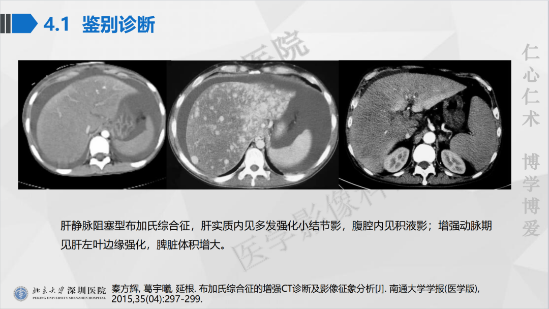 影像PPT - 【PPT】遗传性出血性毛细血管扩张症-38