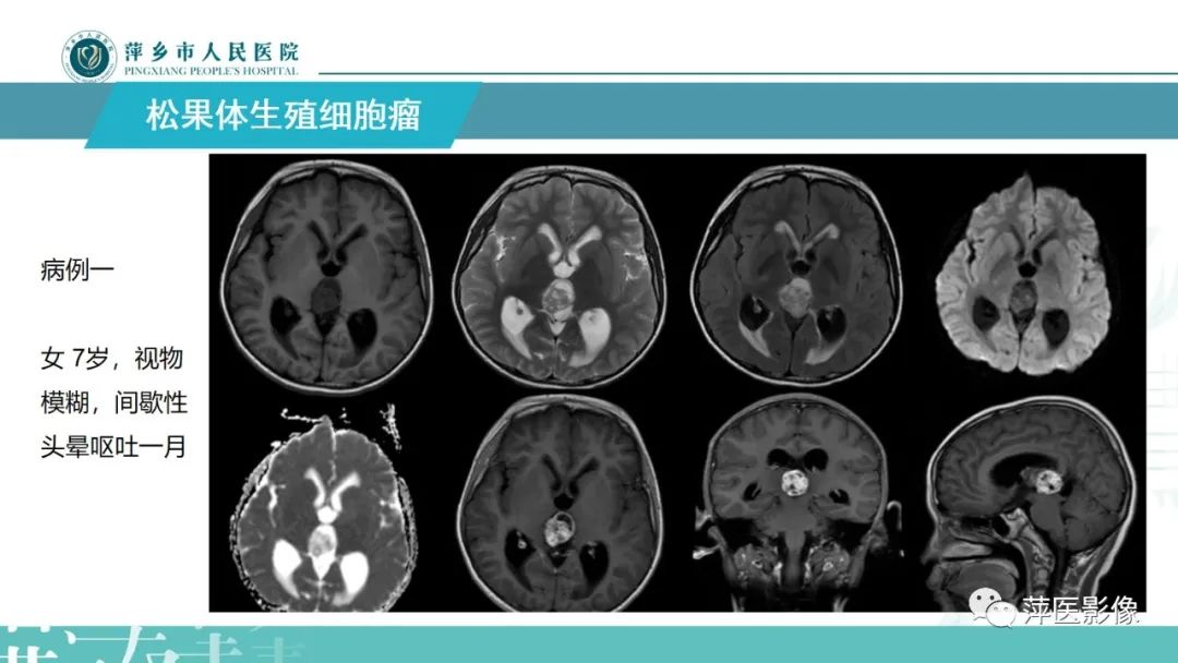 影像PPT - 【PPT】颅内生殖细胞瘤影像表现及鉴别诊断-7