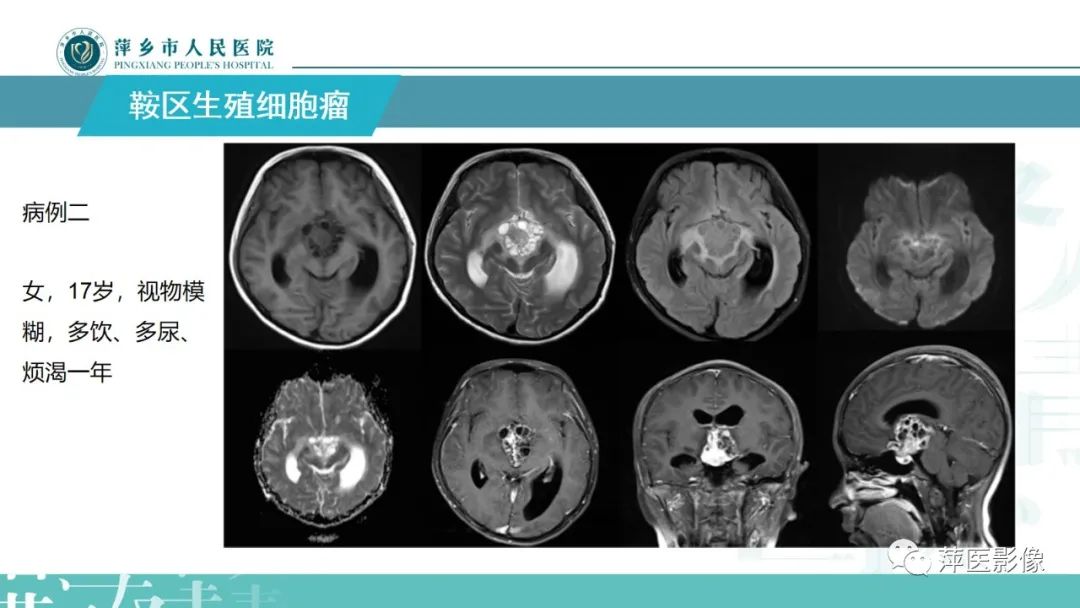 影像PPT - 【PPT】颅内生殖细胞瘤影像表现及鉴别诊断-9