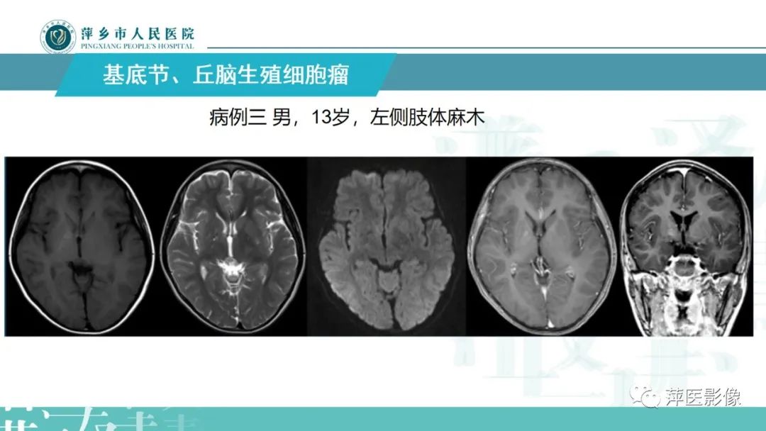 影像PPT - 【PPT】颅内生殖细胞瘤影像表现及鉴别诊断-11