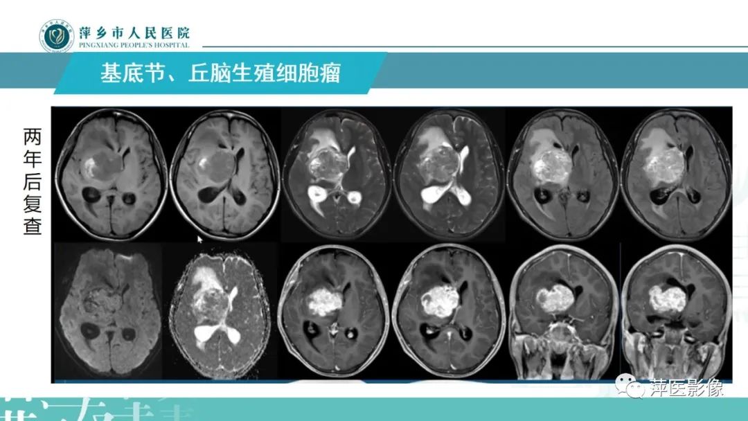 影像PPT - 【PPT】颅内生殖细胞瘤影像表现及鉴别诊断-12
