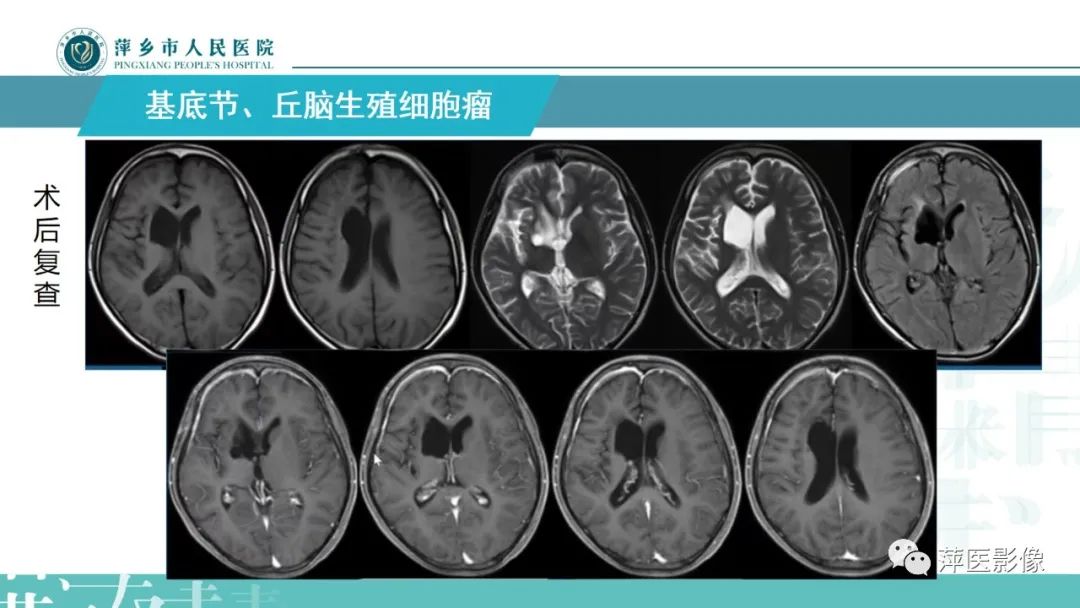 影像PPT - 【PPT】颅内生殖细胞瘤影像表现及鉴别诊断-13