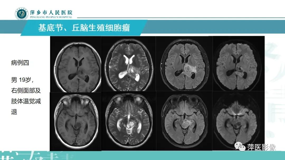 影像PPT - 【PPT】颅内生殖细胞瘤影像表现及鉴别诊断-14