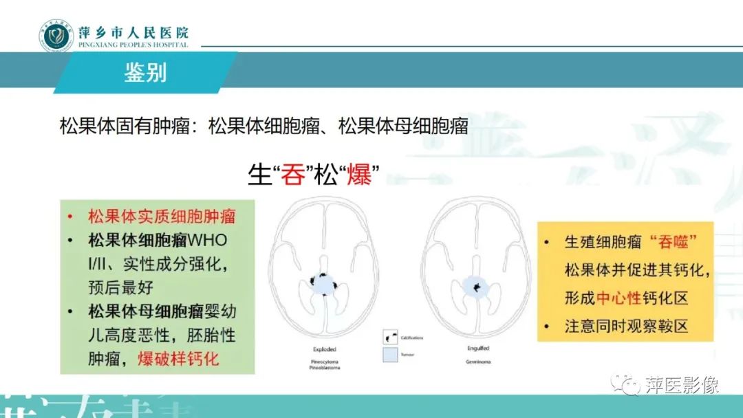 影像PPT - 【PPT】颅内生殖细胞瘤影像表现及鉴别诊断-17