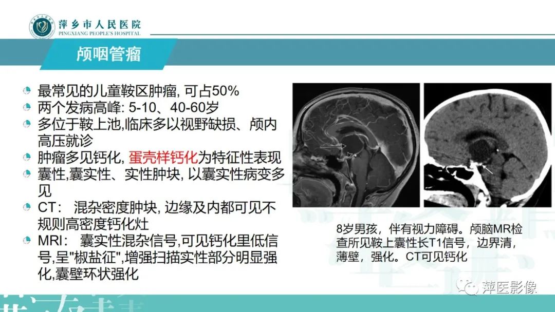 影像PPT - 【PPT】颅内生殖细胞瘤影像表现及鉴别诊断-19