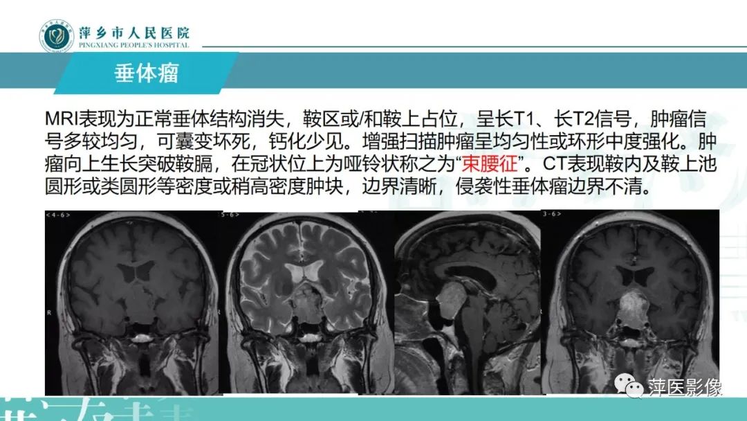 影像PPT - 【PPT】颅内生殖细胞瘤影像表现及鉴别诊断-21