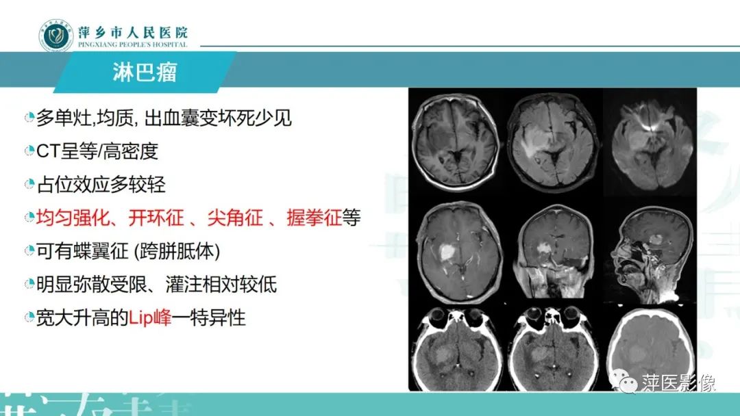 影像PPT - 【PPT】颅内生殖细胞瘤影像表现及鉴别诊断-23