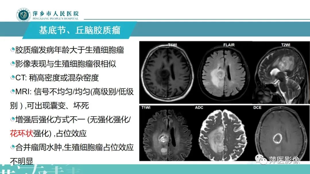 影像PPT - 【PPT】颅内生殖细胞瘤影像表现及鉴别诊断-25