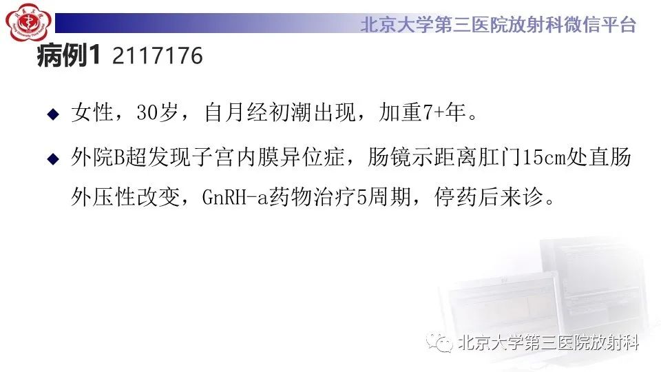 影像PPT - 【PPT】子宫内膜异位症和子宫腺肌症-5