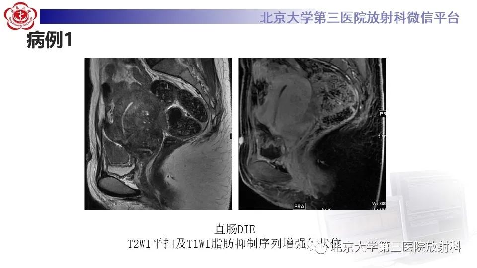 影像PPT - 【PPT】子宫内膜异位症和子宫腺肌症-7