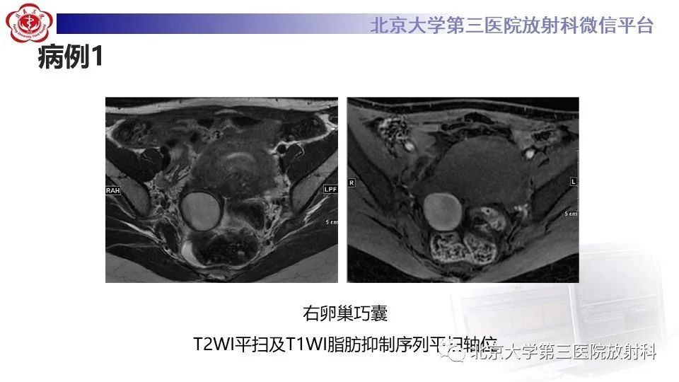 影像PPT - 【PPT】子宫内膜异位症和子宫腺肌症-6