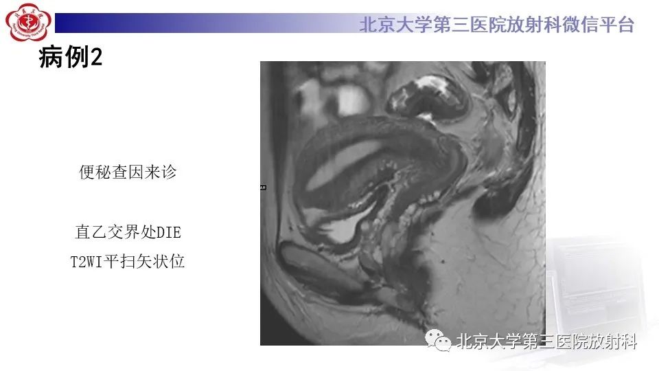 影像PPT - 【PPT】子宫内膜异位症和子宫腺肌症-8