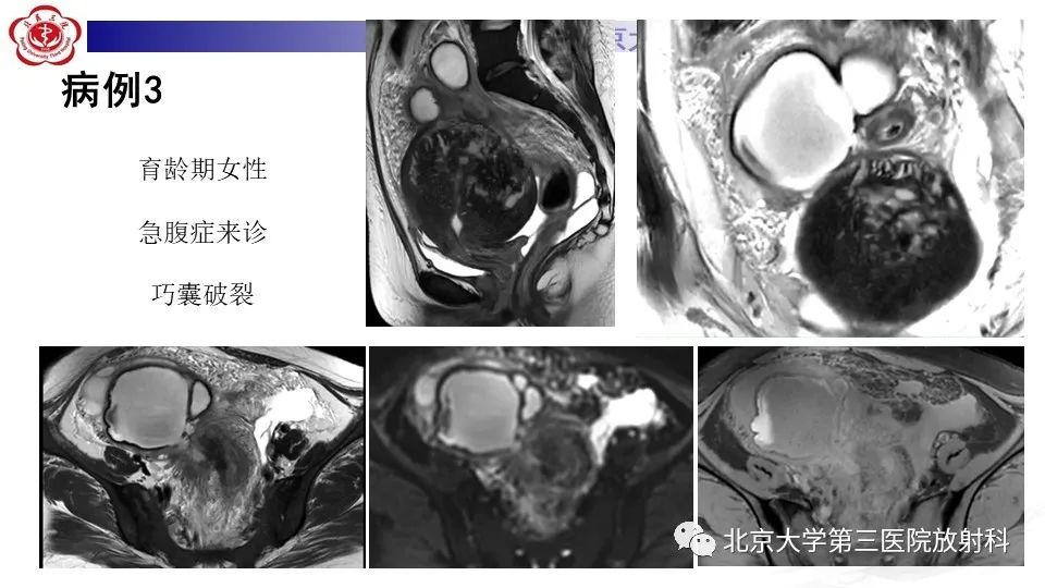 影像PPT - 【PPT】子宫内膜异位症和子宫腺肌症-9