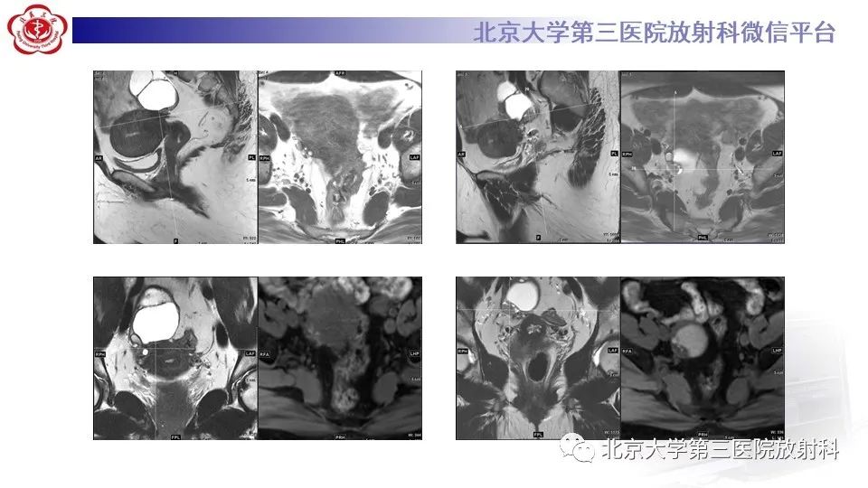影像PPT - 【PPT】子宫内膜异位症和子宫腺肌症-11