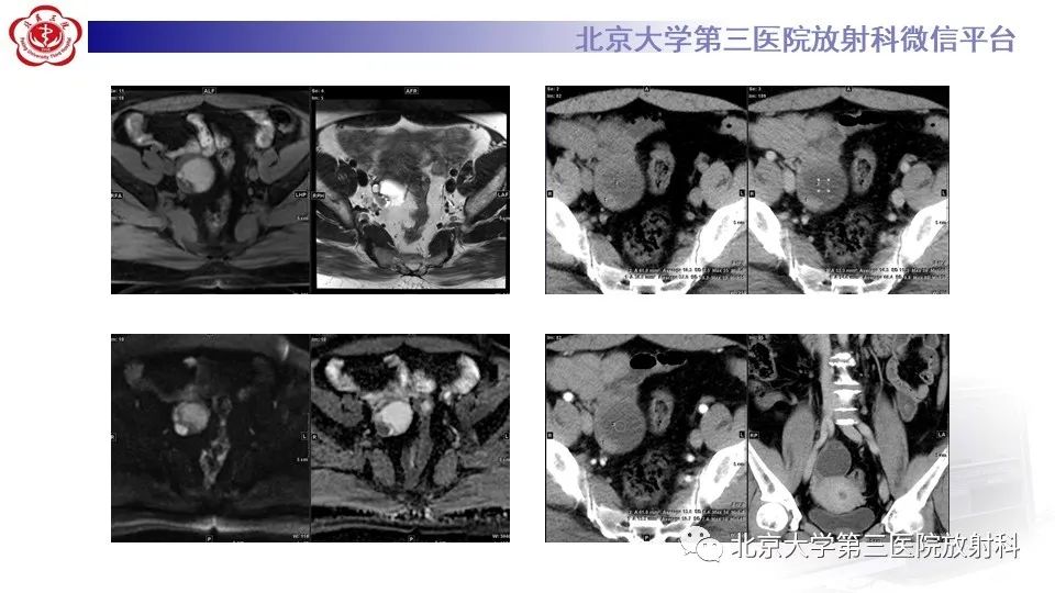 影像PPT - 【PPT】子宫内膜异位症和子宫腺肌症-12