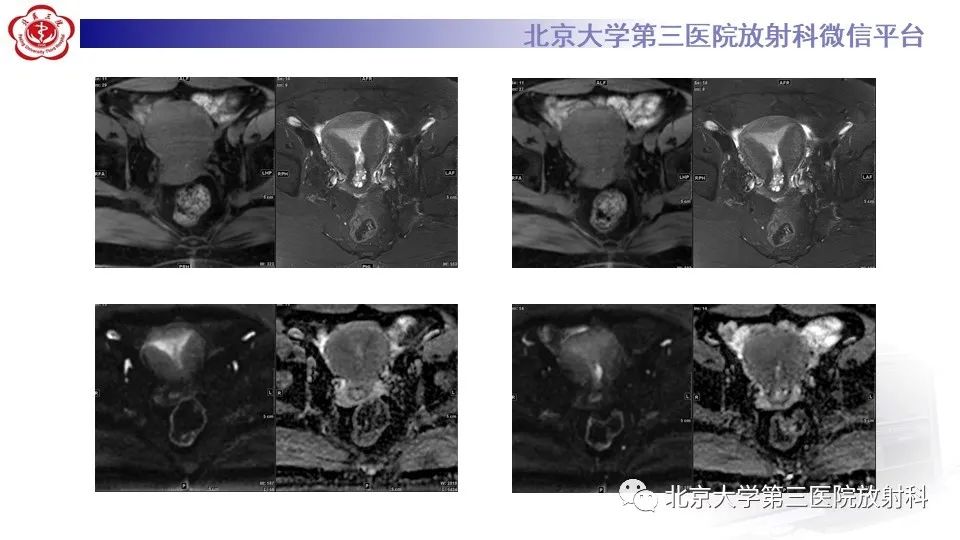 影像PPT - 【PPT】子宫内膜异位症和子宫腺肌症-13