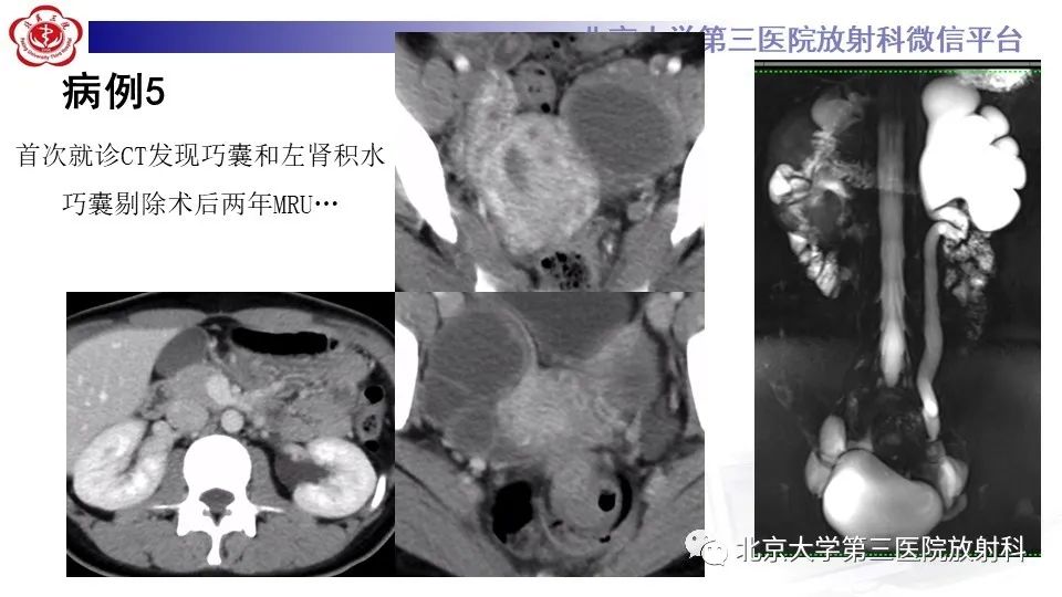 影像PPT - 【PPT】子宫内膜异位症和子宫腺肌症-16