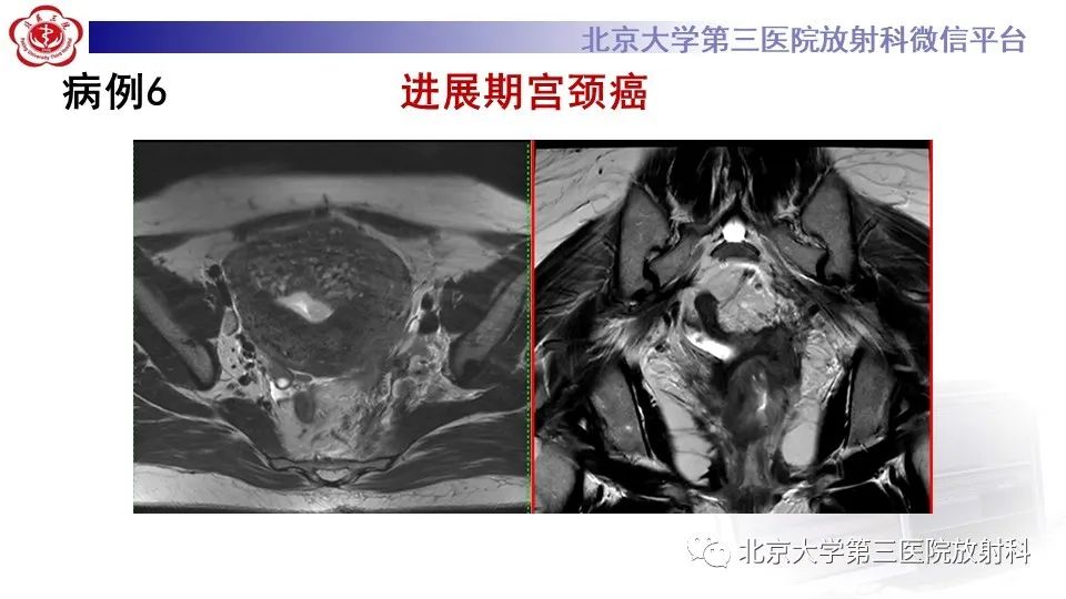 影像PPT - 【PPT】子宫内膜异位症和子宫腺肌症-1