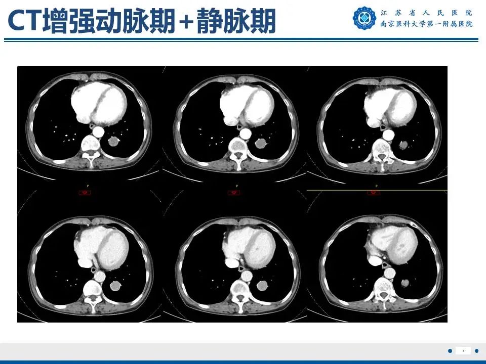 影像PPT - 【PPT】肺硬化性肺泡细胞瘤-5