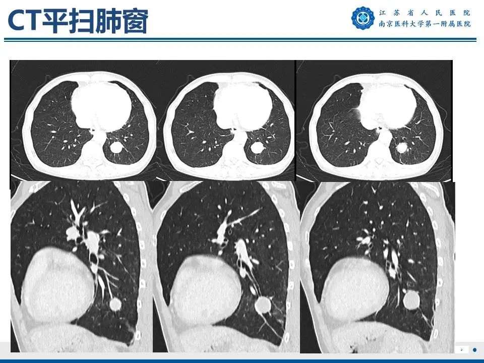 影像PPT - 【PPT】肺硬化性肺泡细胞瘤-3