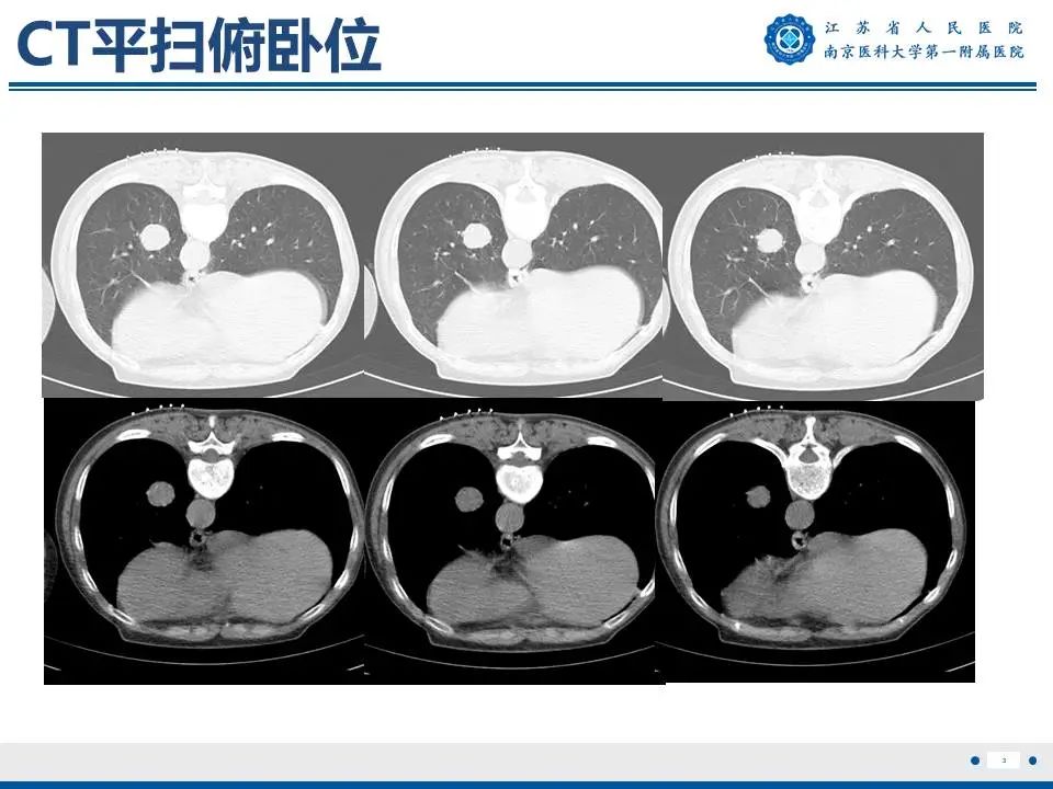 影像PPT - 【PPT】肺硬化性肺泡细胞瘤-4