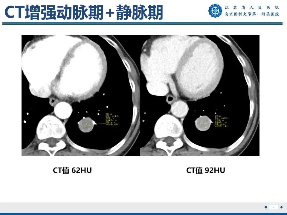 影像PPT - 【PPT】肺硬化性肺泡细胞瘤-6