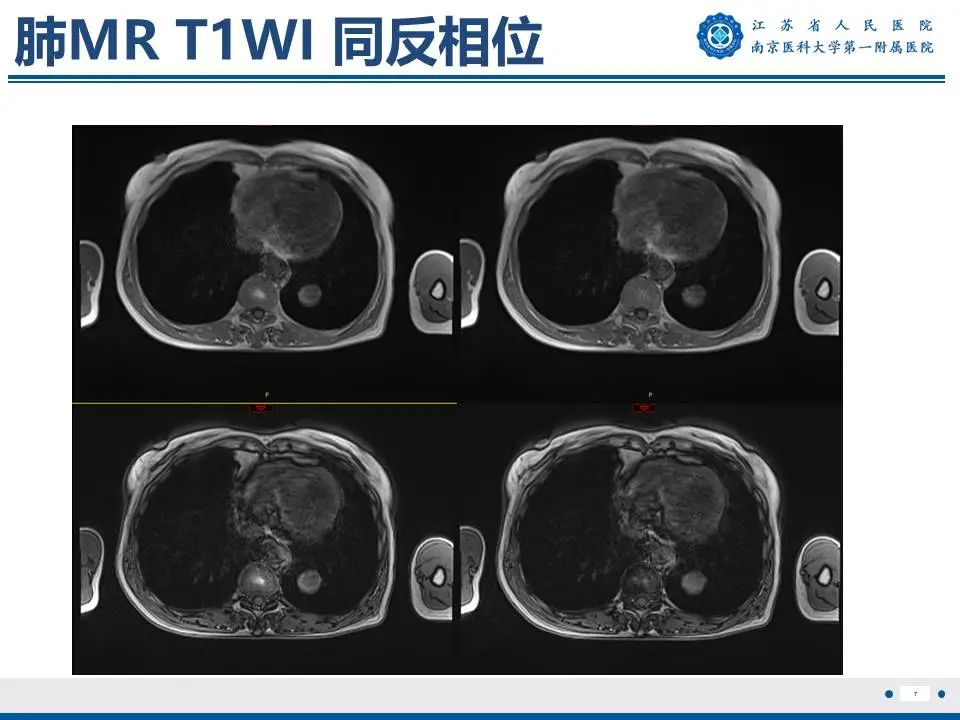 影像PPT - 【PPT】肺硬化性肺泡细胞瘤-8