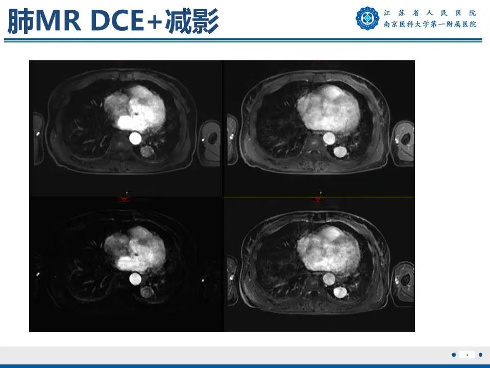 影像PPT - 【PPT】肺硬化性肺泡细胞瘤-10