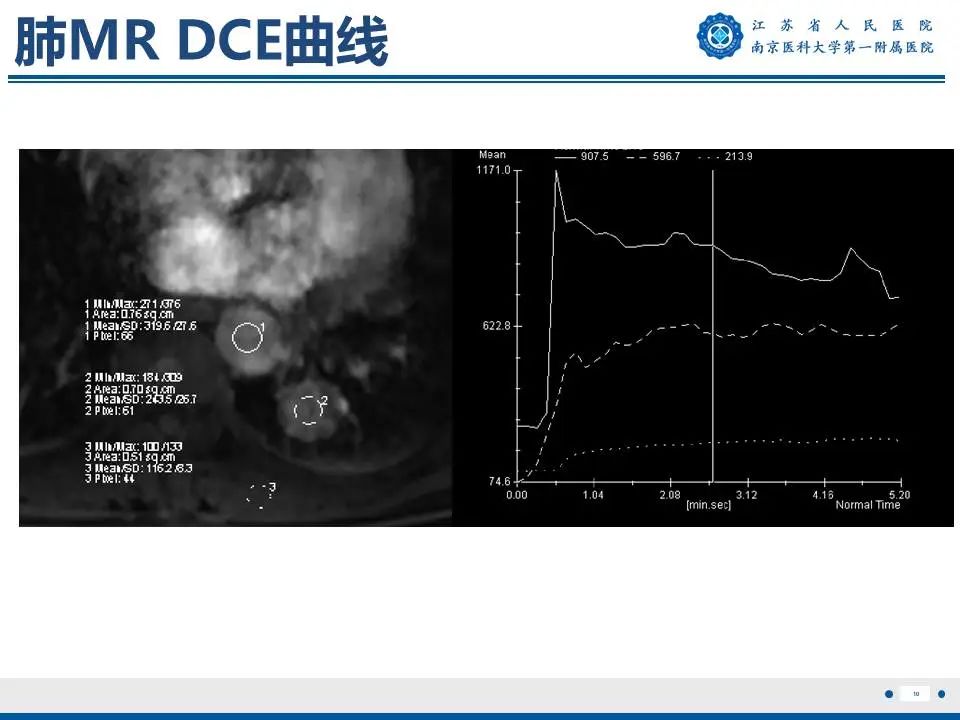 影像PPT - 【PPT】肺硬化性肺泡细胞瘤-11