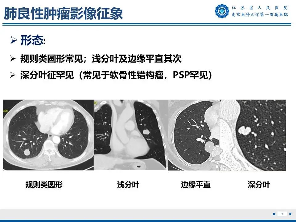 影像PPT - 【PPT】肺硬化性肺泡细胞瘤-17