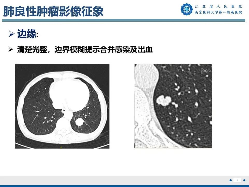 影像PPT - 【PPT】肺硬化性肺泡细胞瘤-18