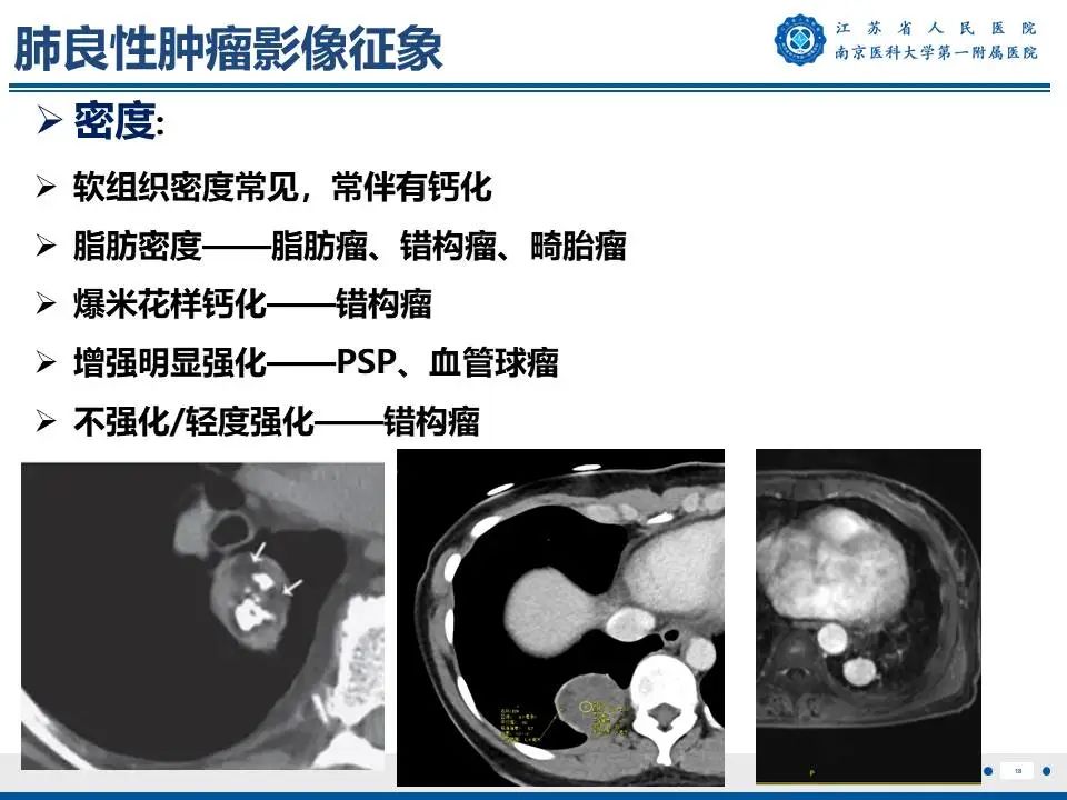 影像PPT - 【PPT】肺硬化性肺泡细胞瘤-19