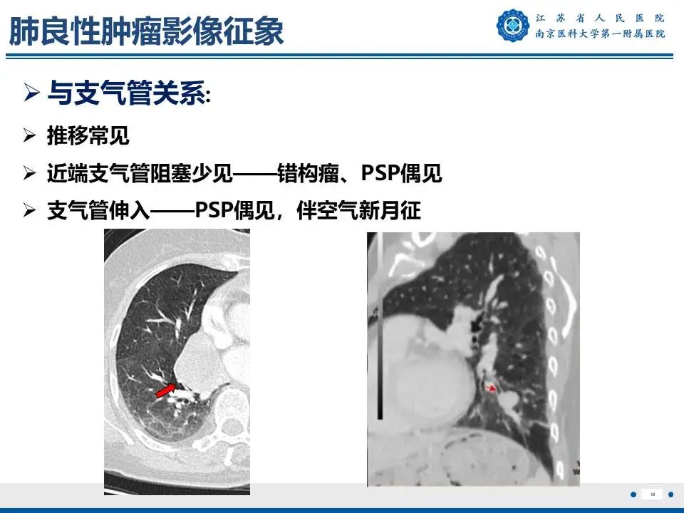 影像PPT - 【PPT】肺硬化性肺泡细胞瘤-20